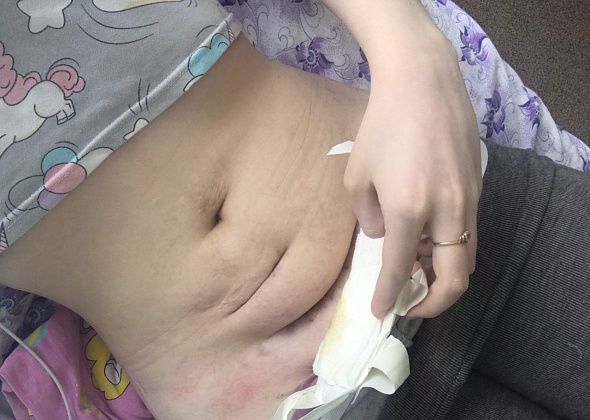 Четыре больницы за плечами. Жительница Карпинска восстанавливается после родов уже два месяца